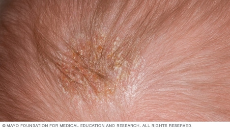 Slide show: Common baby rashes - Mayo Clinic